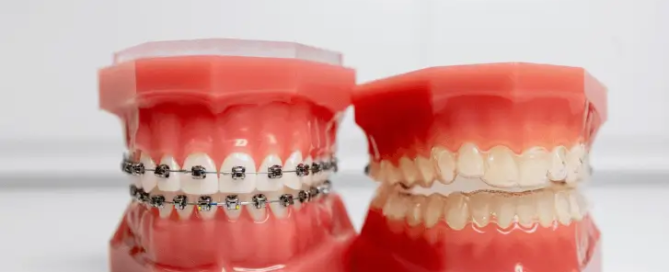Braces-vs.-Invisalign_-What-Orthodontists-Consider-When-Choosing-Between-The-Two-1
