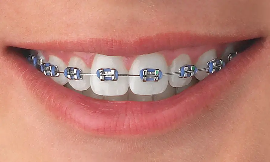 metal_braces_closeup