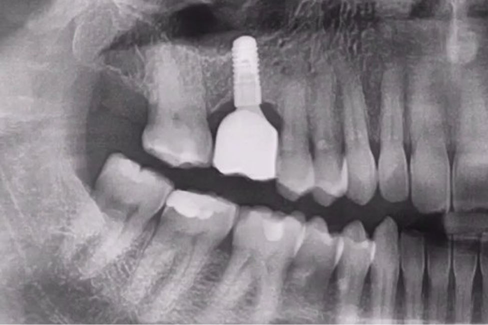 Dental implant X-ray, Alliston Orthodontics & Oral Surgery, Alliston, ON